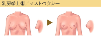 乳房挙上術／マストぺクシー