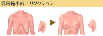 乳房縮小術／リダクション