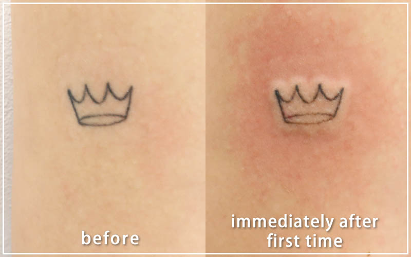 ピコレーザーでの治療　施術前と施術1分後の比較　王冠のマーク