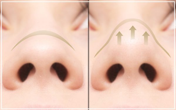 鼻尖縮小手術(鼻尖形成手術)の解説図