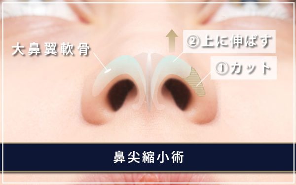 大鼻翼軟骨と施術方法