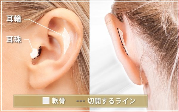 耳輪と耳珠の位置と切開するライン