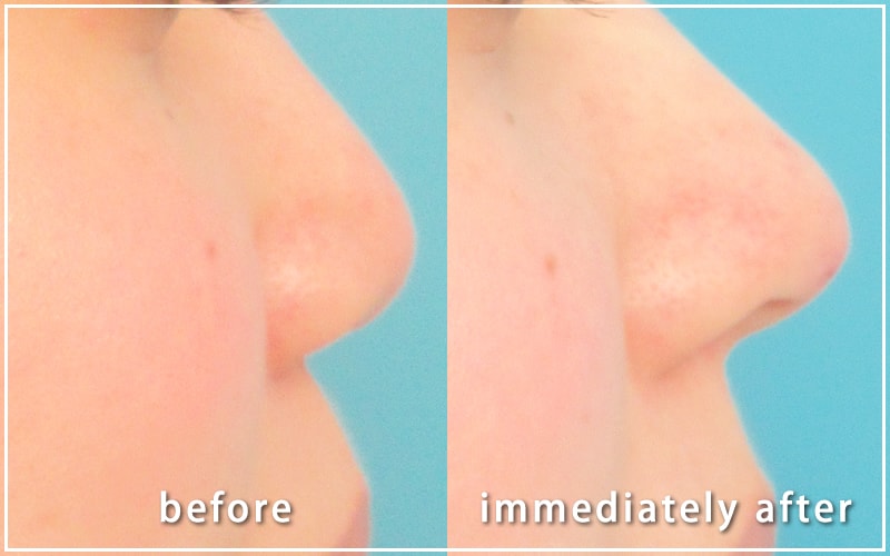 鼻整形の症例写真　術前と術直後の比較