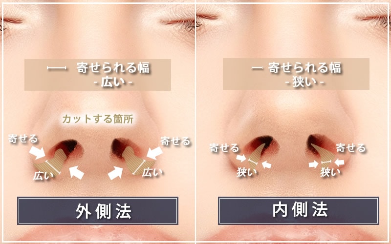 鼻翼縮小手術の手術法（外側法と内側法）の比較