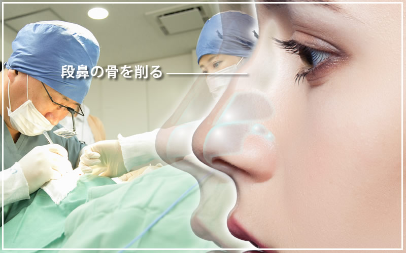 段鼻・鷲鼻の修正手術の様子